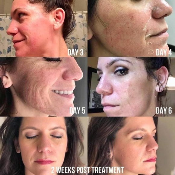 25% TCA Facial Peel - Picture 2 of 6